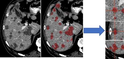 Automated segmentation of colorectal liver metastasis and liver ablation on contrast-enhanced CT images